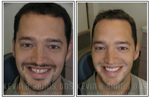 Porcelain Veneers Before and After