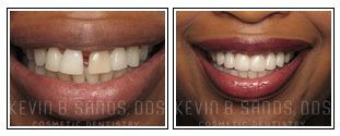 Porcelain Veneers Before and After