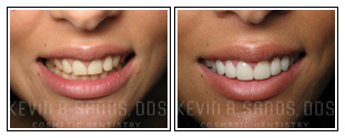 Porcelain Veneers Before and After