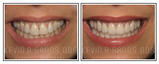 Porcelain Veneers Before and After