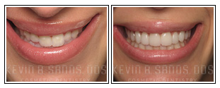 Porcelain Veneers Before and After