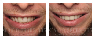 Porcelain Veneers Before and After