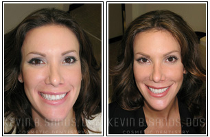 porcelain veneers before and after 2