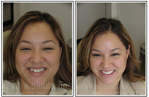 Poecelain Veneers Before and After