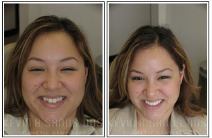 Poecelain Veneers Before and After
