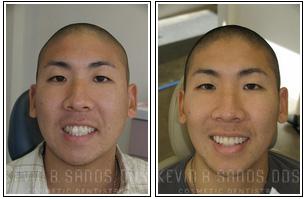 Porcelain Veneers Before and After