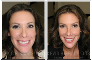 Porcelain Veneers Before and After