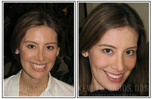 Porcelain Veneers Before and After