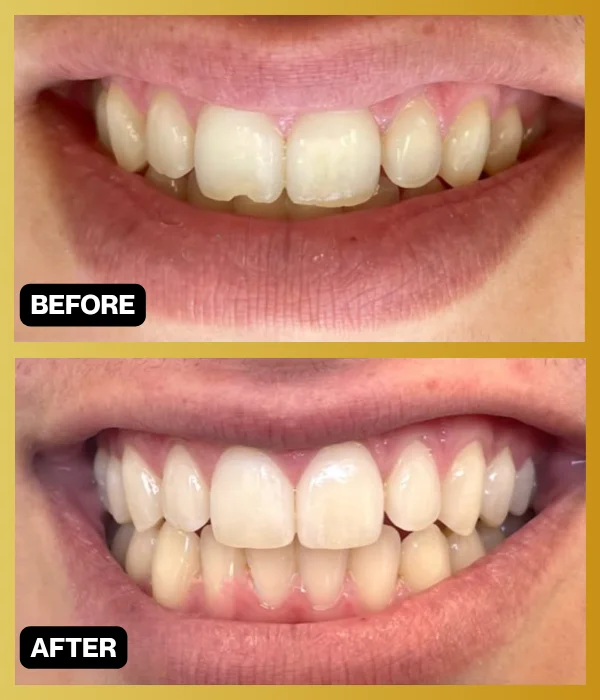 Before and after smile makeover case 2 from Dr. Ghasri’s practice